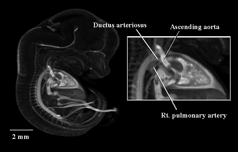 MRI showing detail of heart vasculature